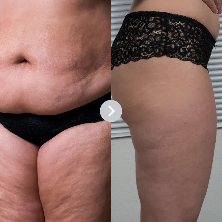 SculptGuard V2 Cellulite Treatments