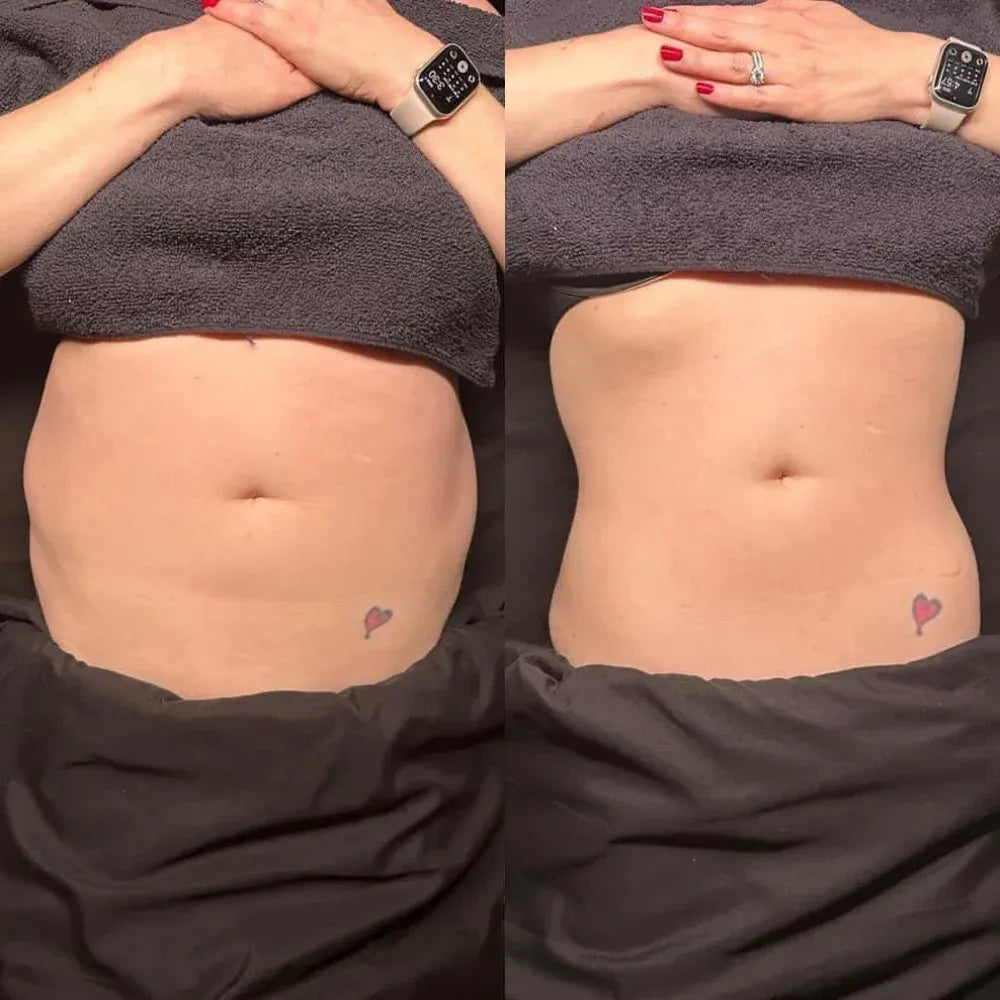 SculptGuard V2 Cellulite Treatments