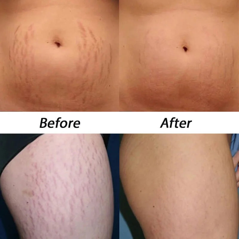 SculptGuard V2 Cellulite Treatments