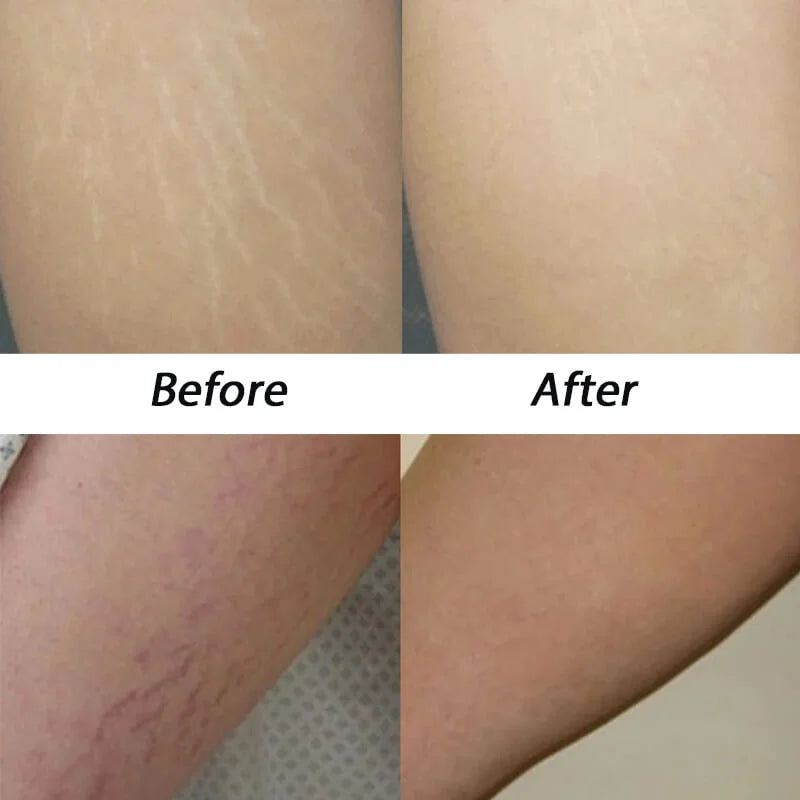SculptGuard V2 Cellulite Treatments